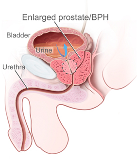 enlarged prostate